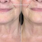 Neck looking lighter and tighter after 2 Jet Plasma treatments