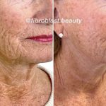 Lower face and neck after 3 Jet Plasma treatments